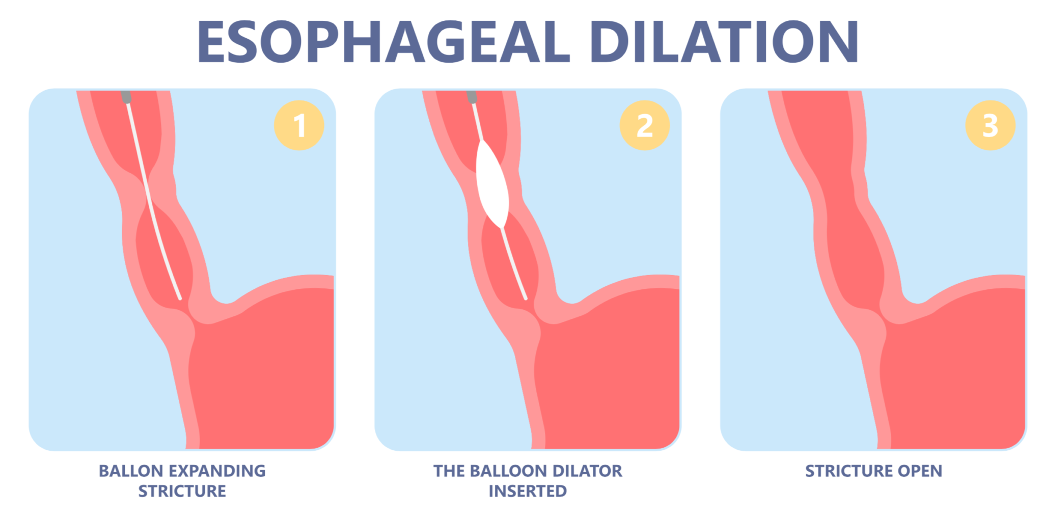 What exactly is Eosinophilic Esophagitis? – EoE Restore | Patient ...